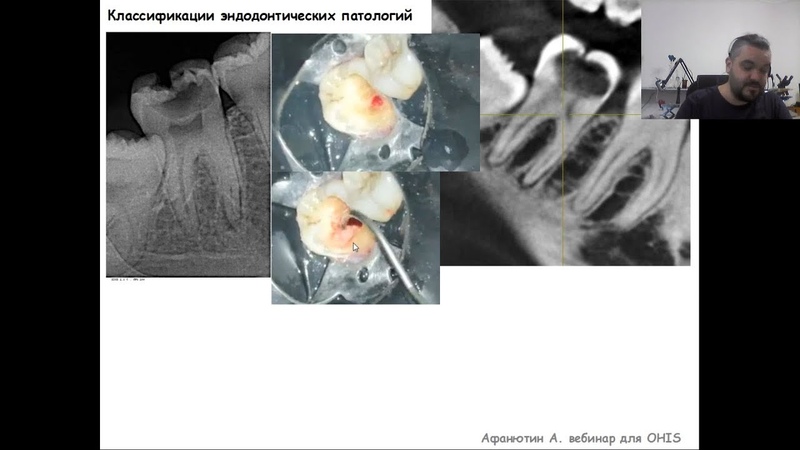 Нестандартный эндодонтический диагноз, Андрей Афанютин, OHI