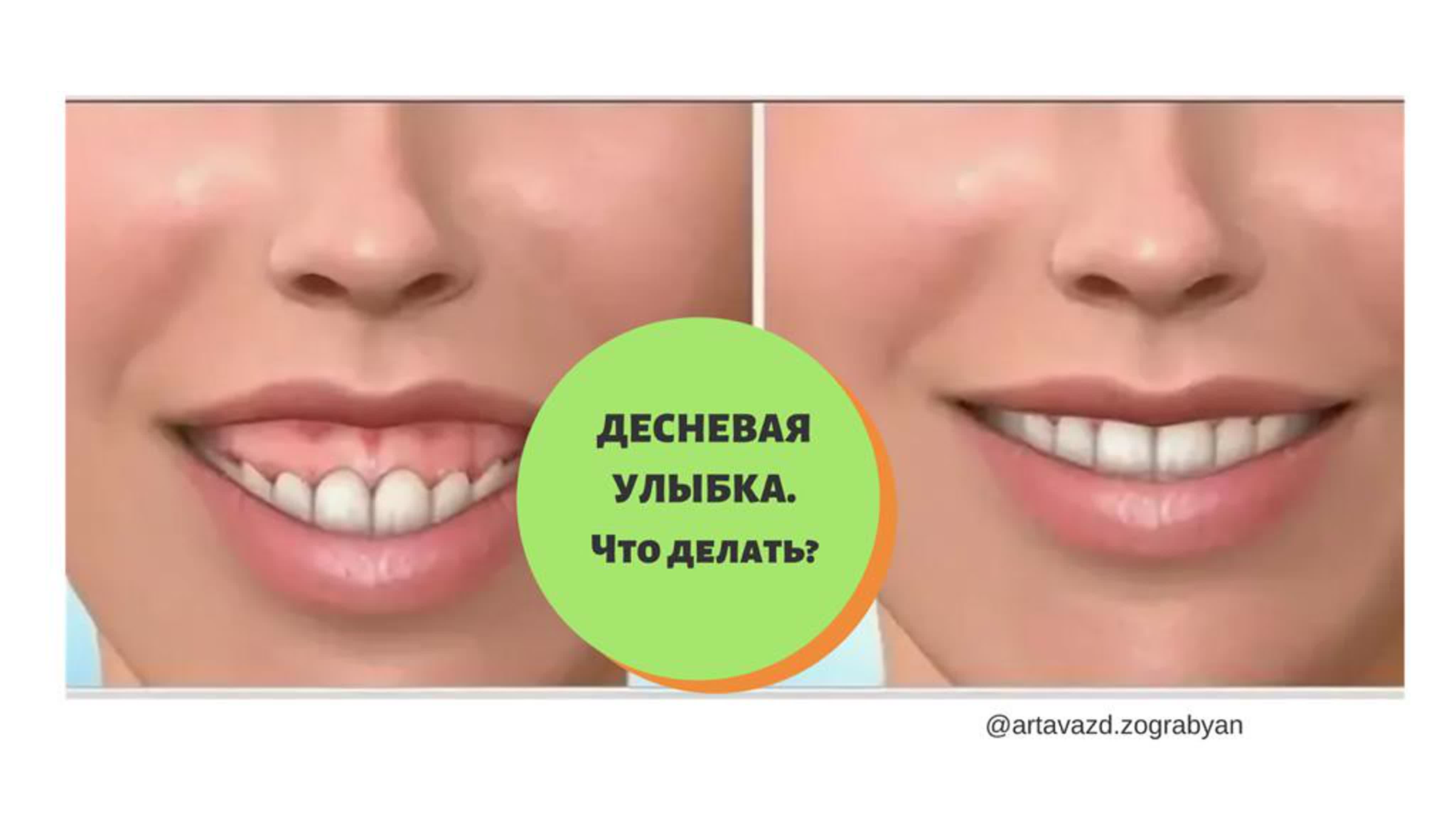 Десневая улыбка уздечка. Ботулинотерапия десневая улыбка. Как убрать десневую улыбку. Исправление десневой улыбки. Коррекция гингивальной улыбки.