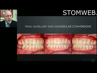 A Treatment For The Prevention of Mandibular Edentulism All On Four For The Mandible