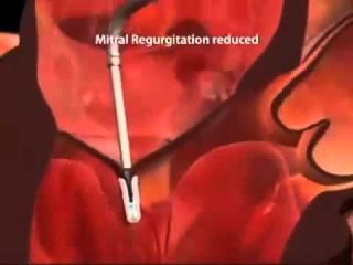 Инновационный метод MitraClip для коррекции митрального клапана